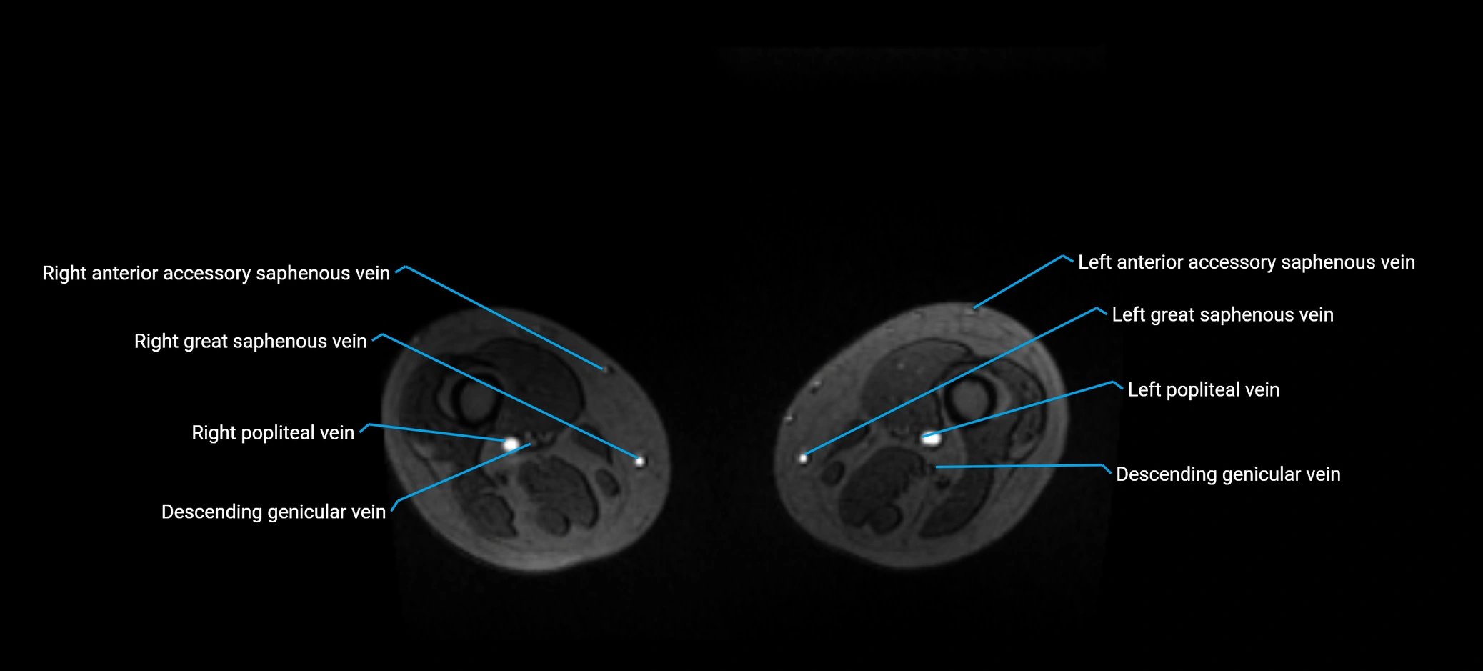MRV abdomen pelvis & lower limb axial cross sectional anatomy labelled MRI image 319.webp